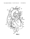 Apparatus for Implanting an Aortic Valve Prosthesis diagram and image