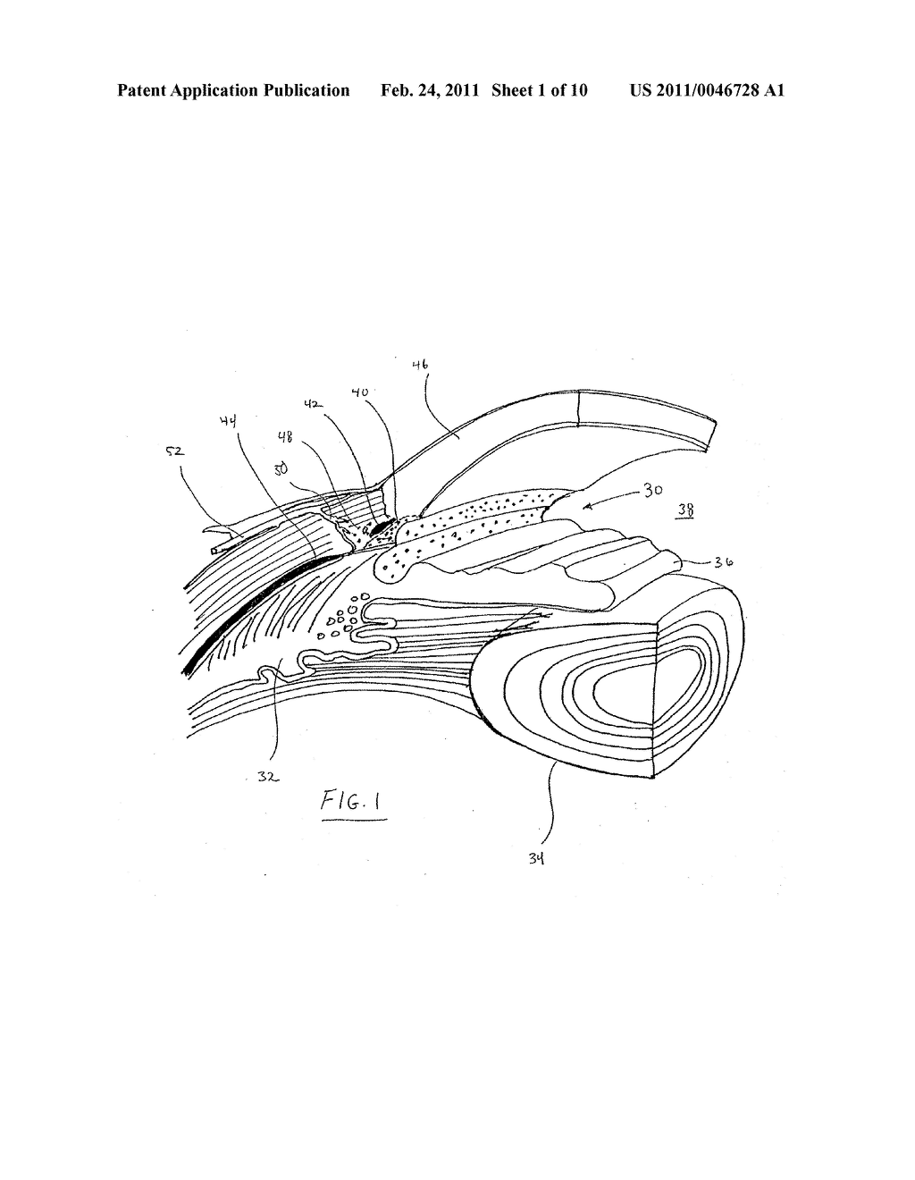 INTRAOCULAR PRESSURE REGULATING DEVICE - diagram, schematic, and image 02