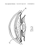 INTRAOCULAR PRESSURE REGULATING DEVICE diagram and image