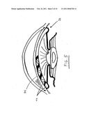 INTRAOCULAR PRESSURE REGULATING DEVICE diagram and image