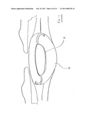 INTRAOCULAR PRESSURE REGULATING DEVICE diagram and image