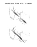 Ligament And Tendon Prosthesis diagram and image