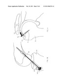 Ligament And Tendon Prosthesis diagram and image