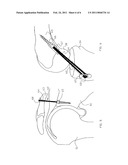 Ligament And Tendon Prosthesis diagram and image