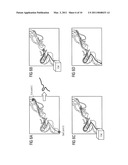 Method for forming an interventional aid with the aid of self-organizing nanorobots consisting of catoms and associated system unit diagram and image