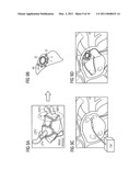 Method for forming an interventional aid with the aid of self-organizing nanorobots consisting of catoms and associated system unit diagram and image