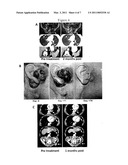 ADOPTIVE CELL THERAPY WITH YOUNG T CELLS diagram and image