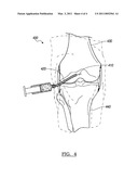 OSTEOLYSIS TREATMENT diagram and image