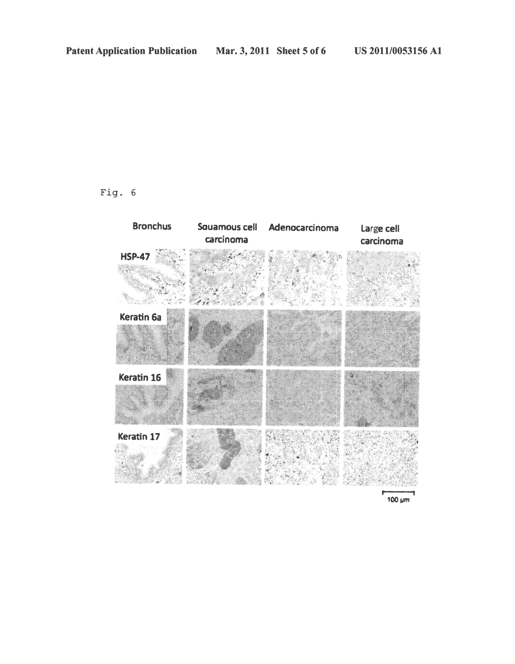 SMALL CELL LUNG CARCINOMA BIOMARKER PANEL - diagram, schematic, and image 06