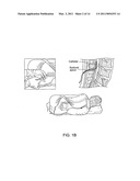 Spinal canal access and probe positioning, devices and methods diagram and image