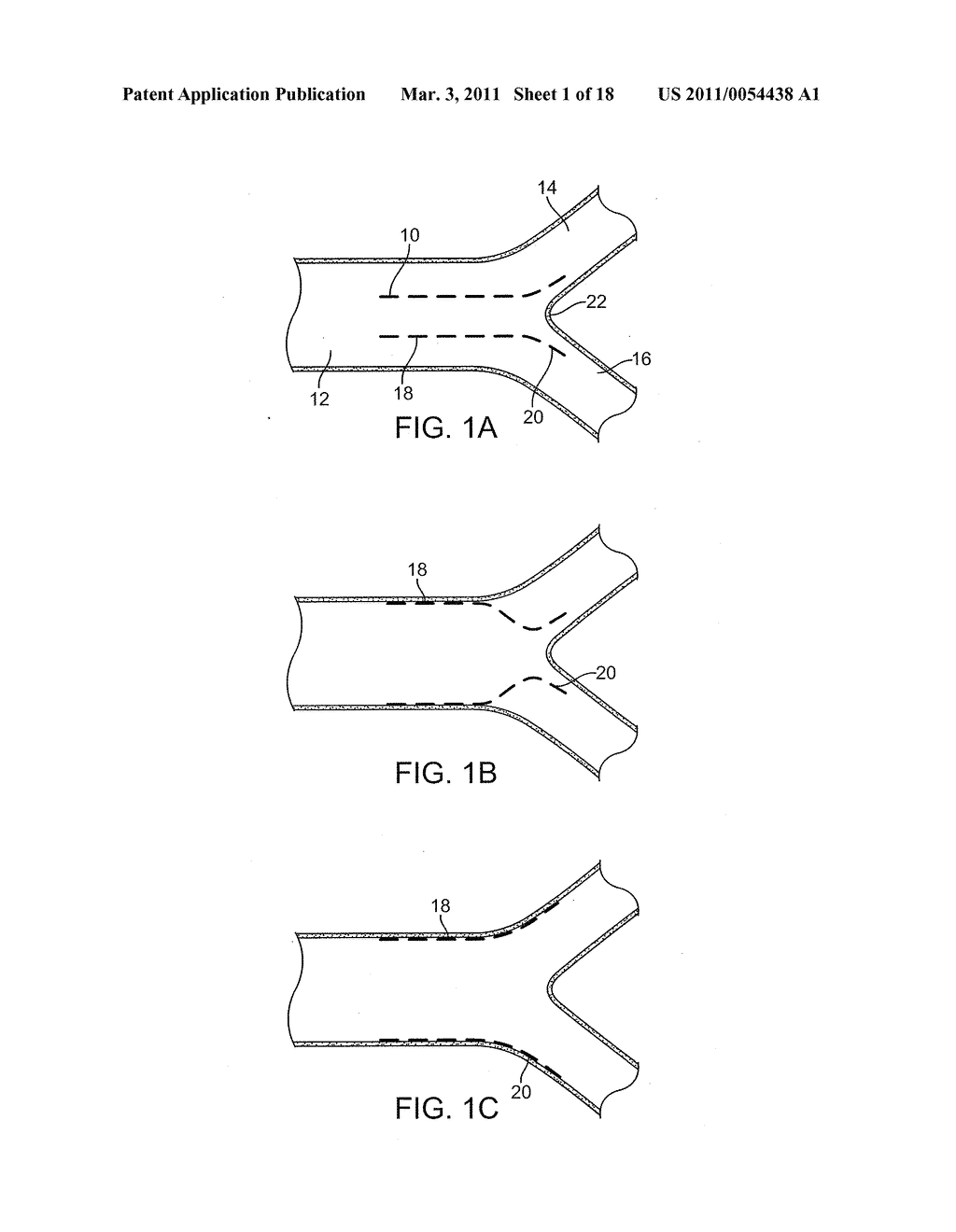 STENT DELIVERY AT A BIFURCATION, SYSTEMS AND METHODS - diagram, schematic, and image 02