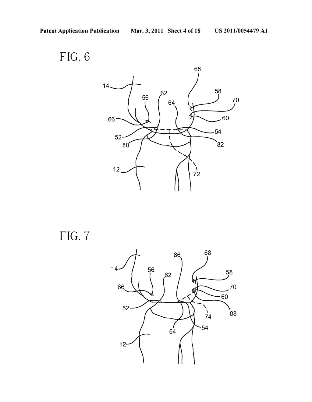 METHOD FOR ARTHROSCOPIC BONE PREPARATION - diagram, schematic, and image 05