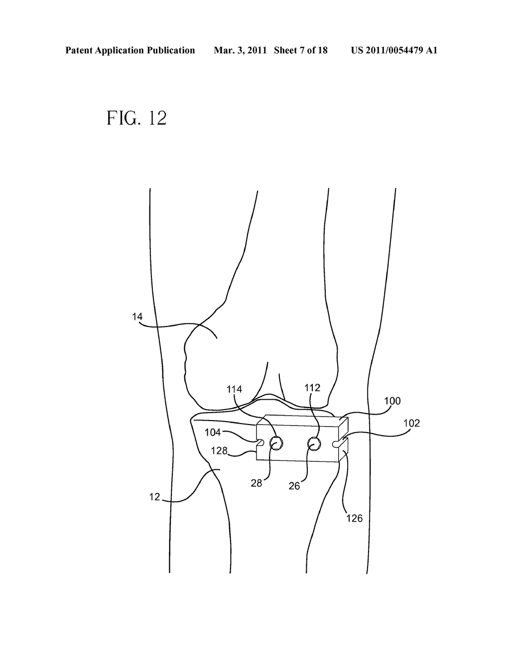 METHOD FOR ARTHROSCOPIC BONE PREPARATION - diagram, schematic, and image 08