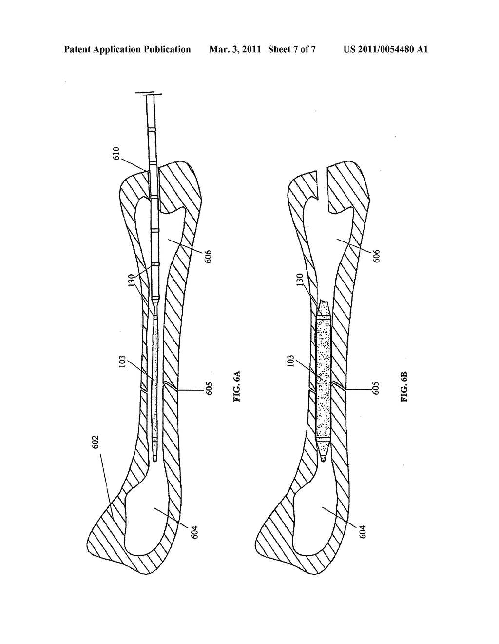 Internal Bone Fixation System with Integrated Mixer - diagram, schematic, and image 08