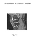 Devices, Methods, and Systems for Prosthetic Meniscus Selection, Trialing, and Implantation diagram and image