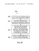 Devices, Methods, and Systems for Prosthetic Meniscus Selection, Trialing, and Implantation diagram and image