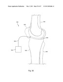Devices, Methods, and Systems for Prosthetic Meniscus Selection, Trialing, and Implantation diagram and image