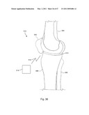 Devices, Methods, and Systems for Prosthetic Meniscus Selection, Trialing, and Implantation diagram and image