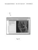 Devices, Methods, and Systems for Prosthetic Meniscus Selection, Trialing, and Implantation diagram and image