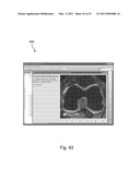 Devices, Methods, and Systems for Prosthetic Meniscus Selection, Trialing, and Implantation diagram and image