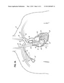 COAXIAL TRANSSEPTAL GUIDE-WIRE AND NEEDLE ASSEMBLY diagram and image