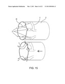 VASCULAR CLIP diagram and image