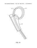 VASCULAR CLIP diagram and image