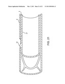 VASCULAR CLIP diagram and image