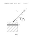 METHOD FOR CLOSING AN APERTURE IN A PATIENT S BODY diagram and image