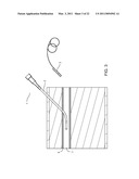 METHOD FOR CLOSING AN APERTURE IN A PATIENT S BODY diagram and image