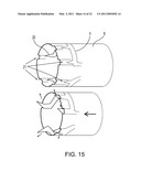 METHOD FOR CLOSING AN APERTURE IN A PATIENT S BODY diagram and image