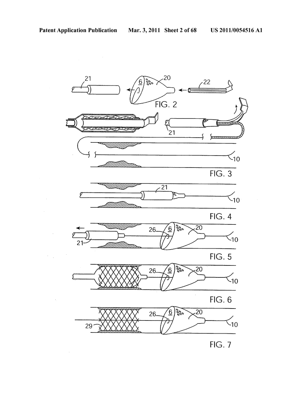 EMBOLIC PROTECTION METHOD - diagram, schematic, and image 03