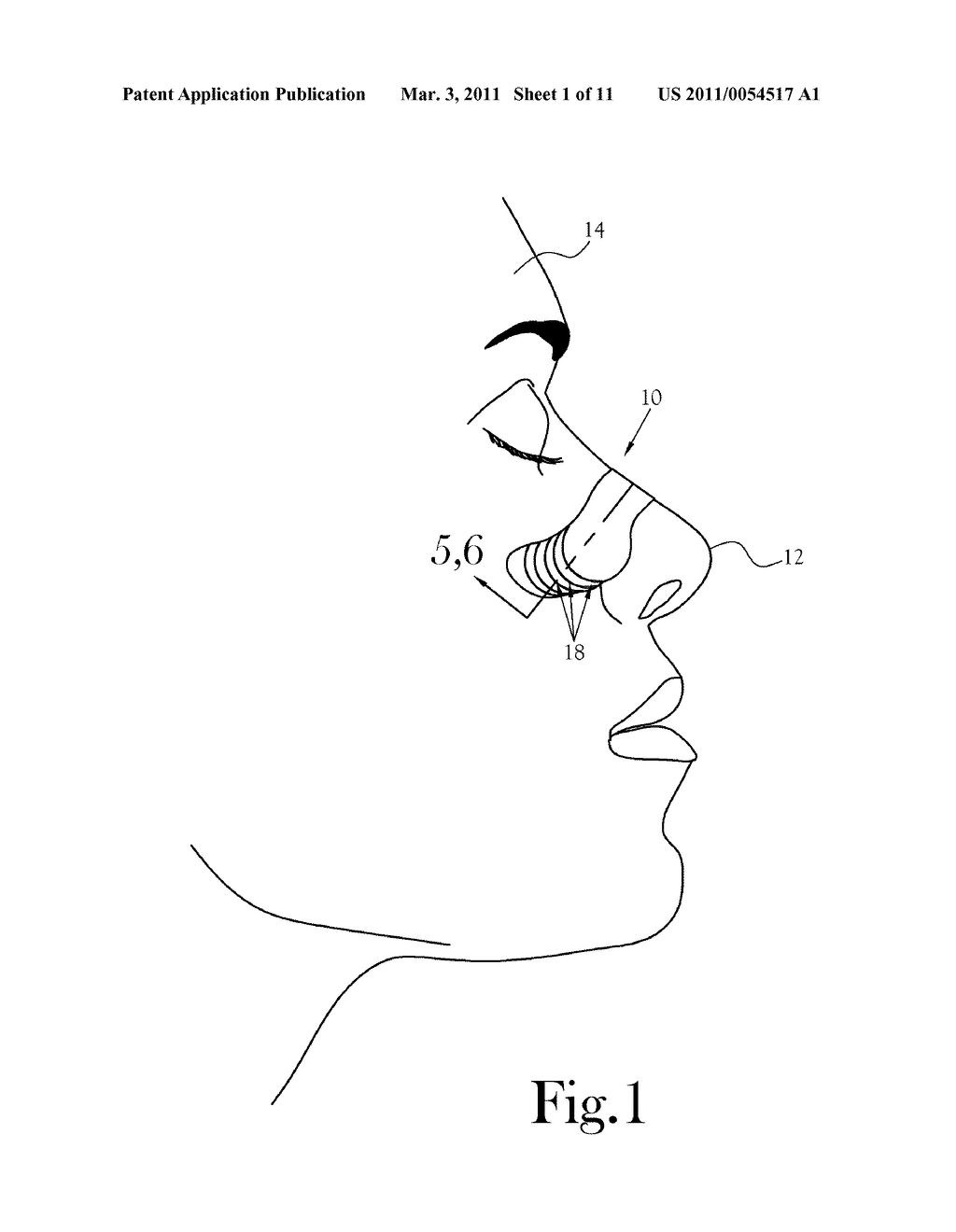 EXTERNAL NASAL DILATOR AND METHODS OF MANUFACTURE - diagram, schematic, and image 02