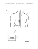 DORSAL COLUMN STIMULATION THERAPY diagram and image