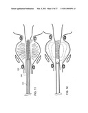 IMPLANTABLE MEDICAL DEVICES diagram and image