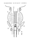 IMPLANTABLE MEDICAL DEVICES diagram and image