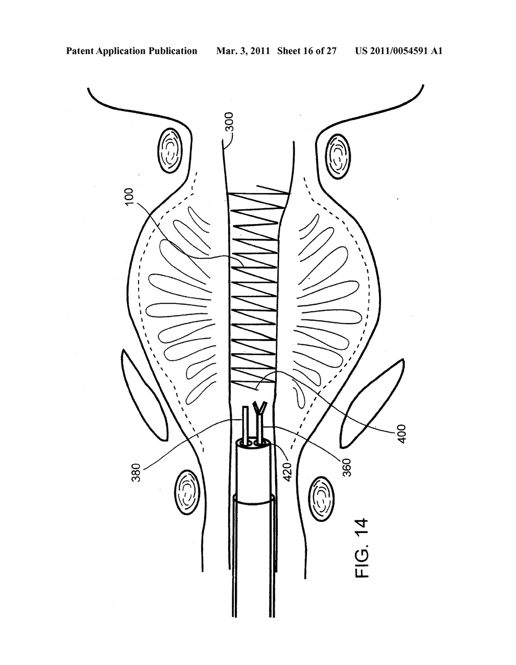 IMPLANTABLE MEDICAL DEVICES - diagram, schematic, and image 17