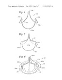 Contoured Sewing Ring for a Prosthetic Mitral Heart Valve diagram and image