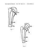 HUMERAL JOINT REPLACEMENT COMPONENT diagram and image