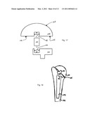 HUMERAL JOINT REPLACEMENT COMPONENT diagram and image