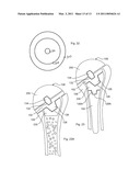 HUMERAL JOINT REPLACEMENT COMPONENT diagram and image