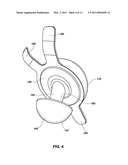 REFLEX FIXATION GEOMETRY REVISION AND RECONSTRUCTION SYSTEM REVERSE ARTICULATION diagram and image