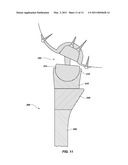 REFLEX FIXATION GEOMETRY REVISION AND RECONSTRUCTION SYSTEM REVERSE ARTICULATION diagram and image