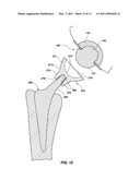 REFLEX FIXATION GEOMETRY REVISION AND RECONSTRUCTION SYSTEM REVERSE ARTICULATION diagram and image