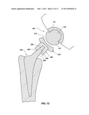 REFLEX FIXATION GEOMETRY REVISION AND RECONSTRUCTION SYSTEM REVERSE ARTICULATION diagram and image