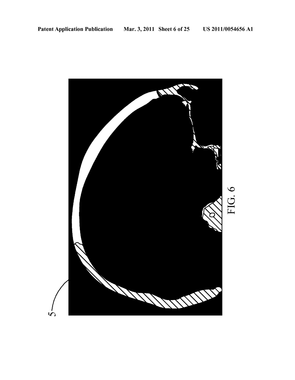 METHOD FOR MANUFACTURING ARTIFICIAL IMPLANTS - diagram, schematic, and image 07