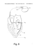 DETERMINATION OF DIASTOLIC HEART FAILURE diagram and image