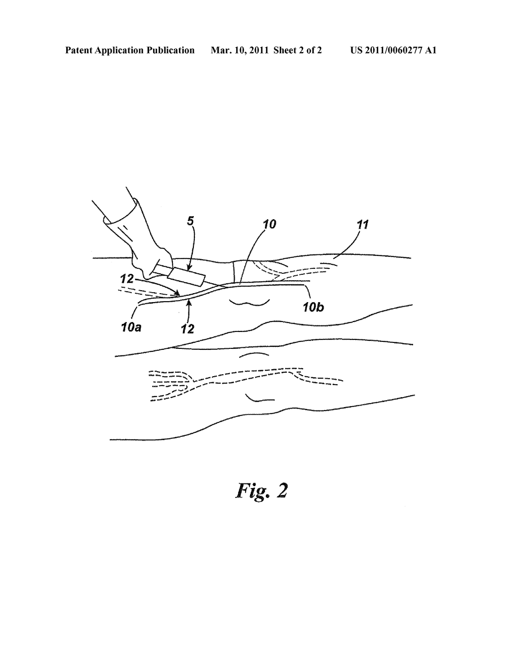 VARICOSE VEIN TREATMENT - diagram, schematic, and image 03