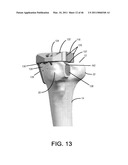 IMPLANTS WITH TRANSITION SURFACES AND RELATED PROCESSES diagram and image