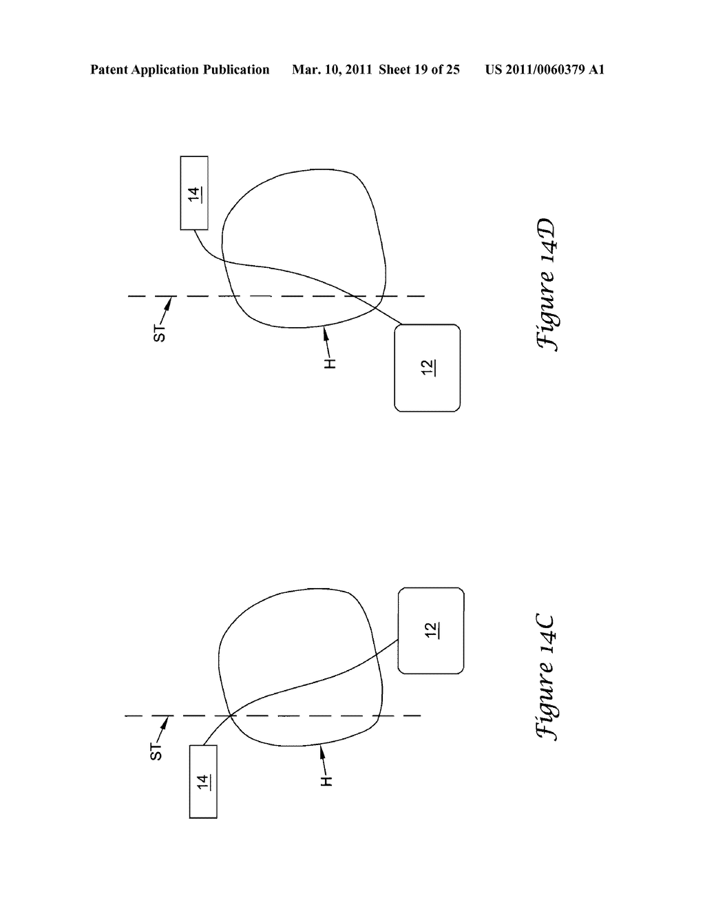 Anterior Active Housing Subcutaneous Positioning Methods - diagram, schematic, and image 20